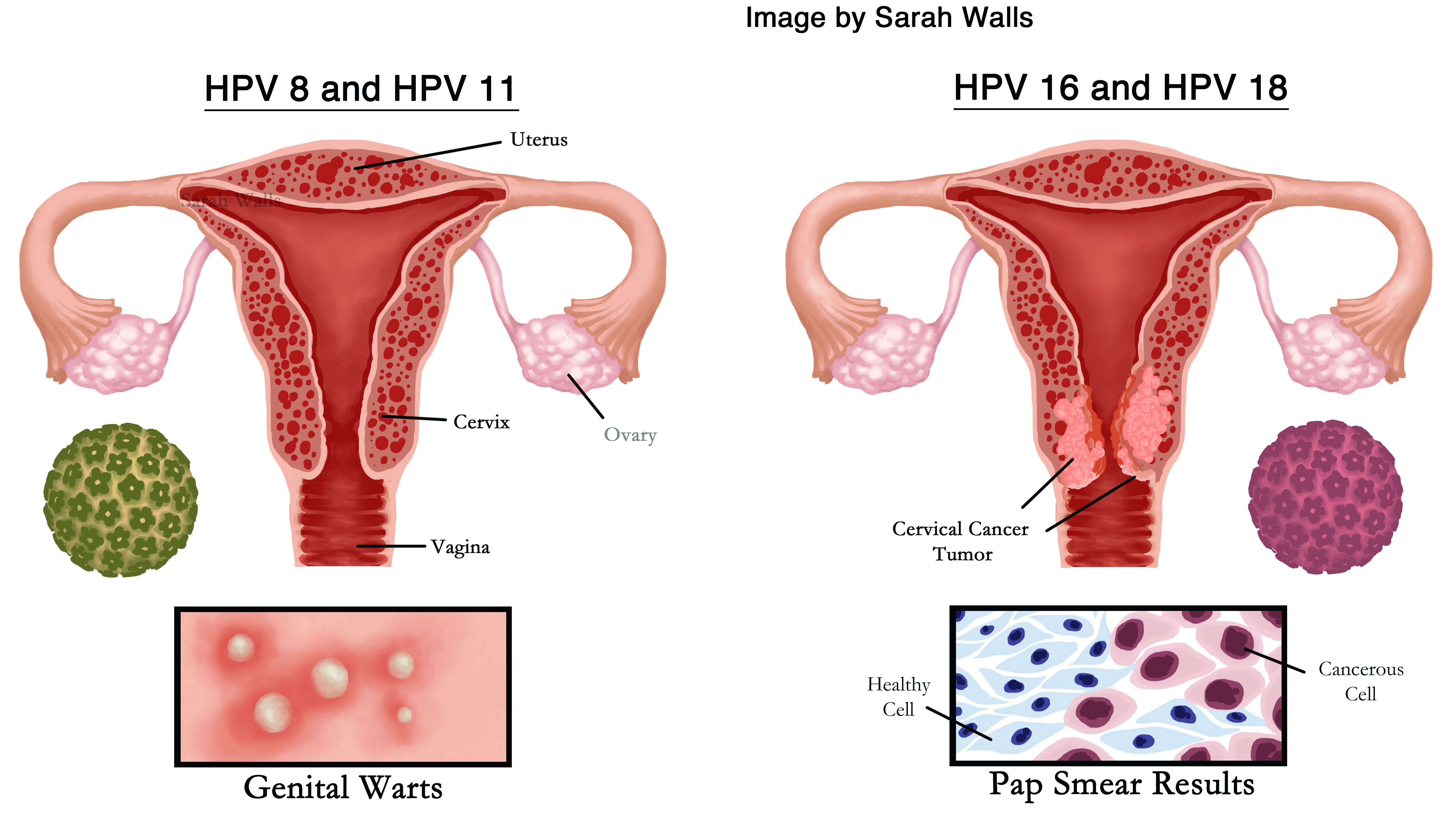 HPV نوع 16