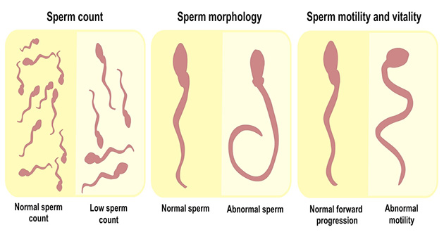 اسپرم گرام Spermogram or Semen