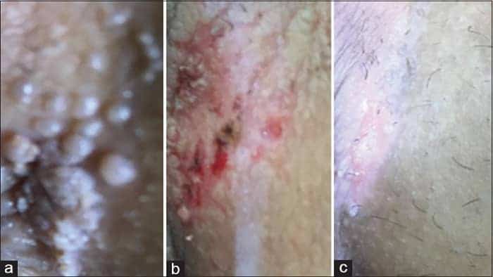 زگیل تناسلی | علائم و آزمایش های تشخیصی